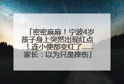 密密麻麻！宁波4岁孩子身上突然出现红点！连小便都变红了……家长：以为只是摔伤